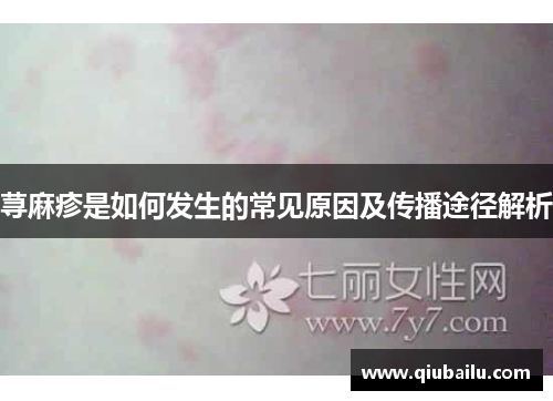荨麻疹是如何发生的常见原因及传播途径解析