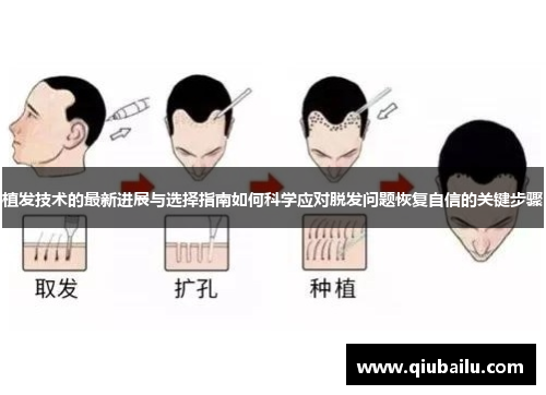 植发技术的最新进展与选择指南如何科学应对脱发问题恢复自信的关键步骤